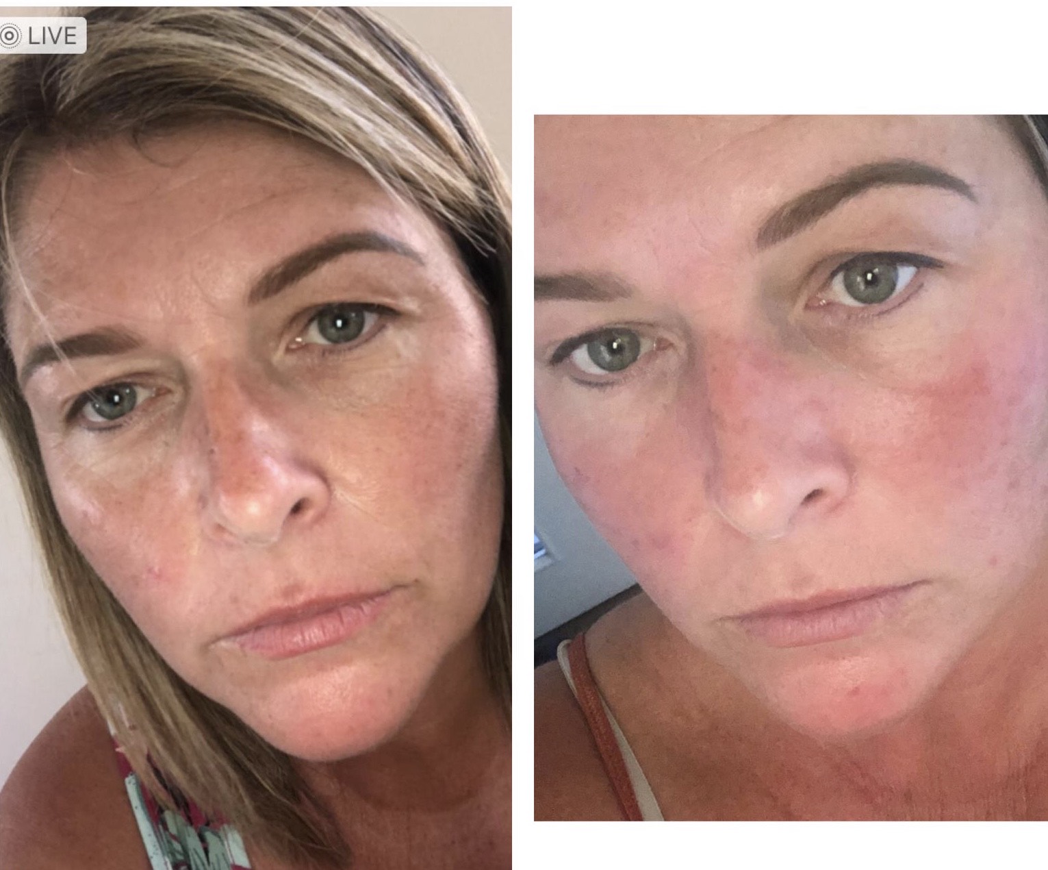 Fractional laser acne and scars result 1