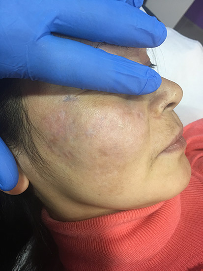 Fractional laser acne and scars result 3