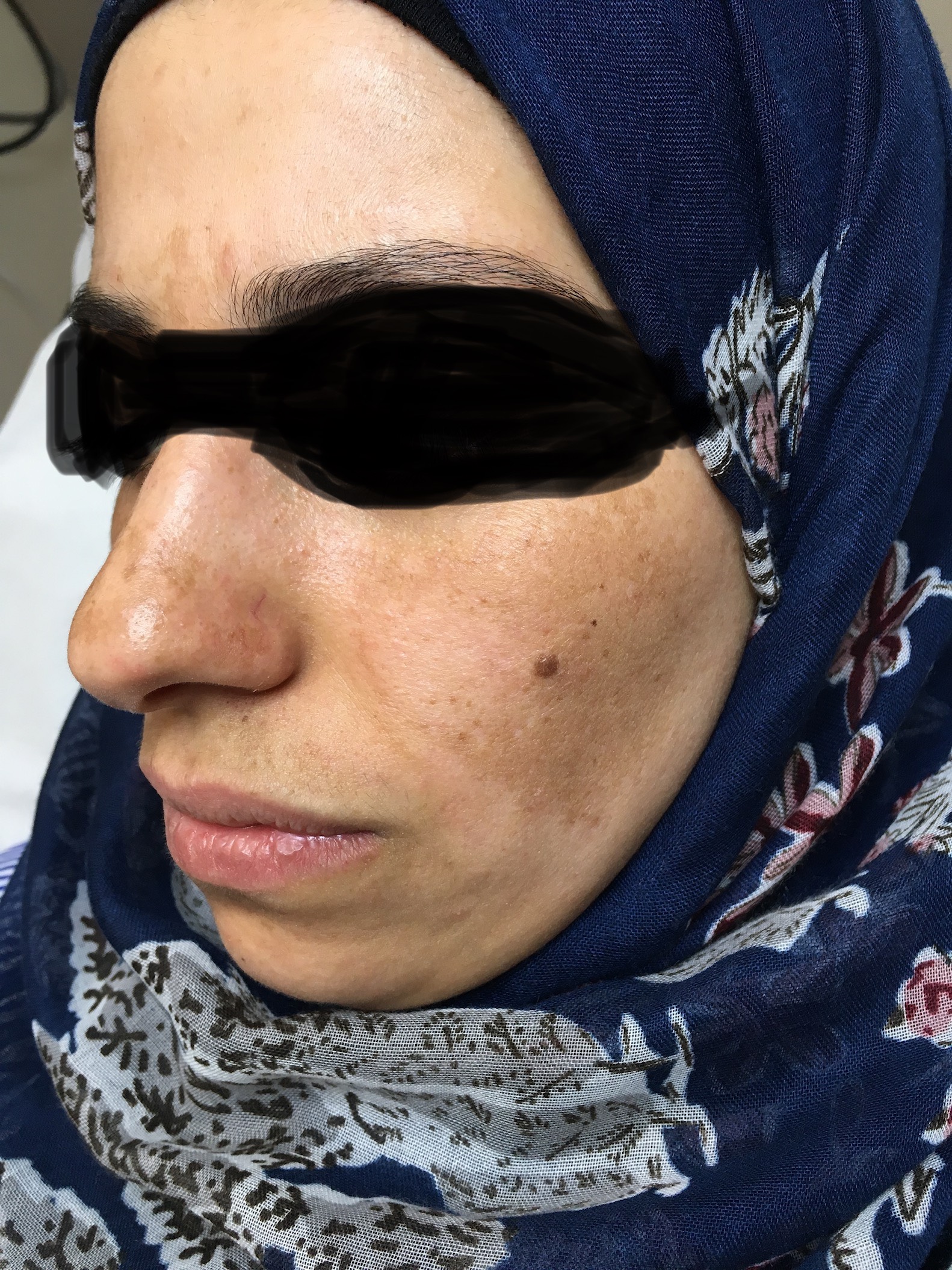 Fractional laser acne and scars result 5