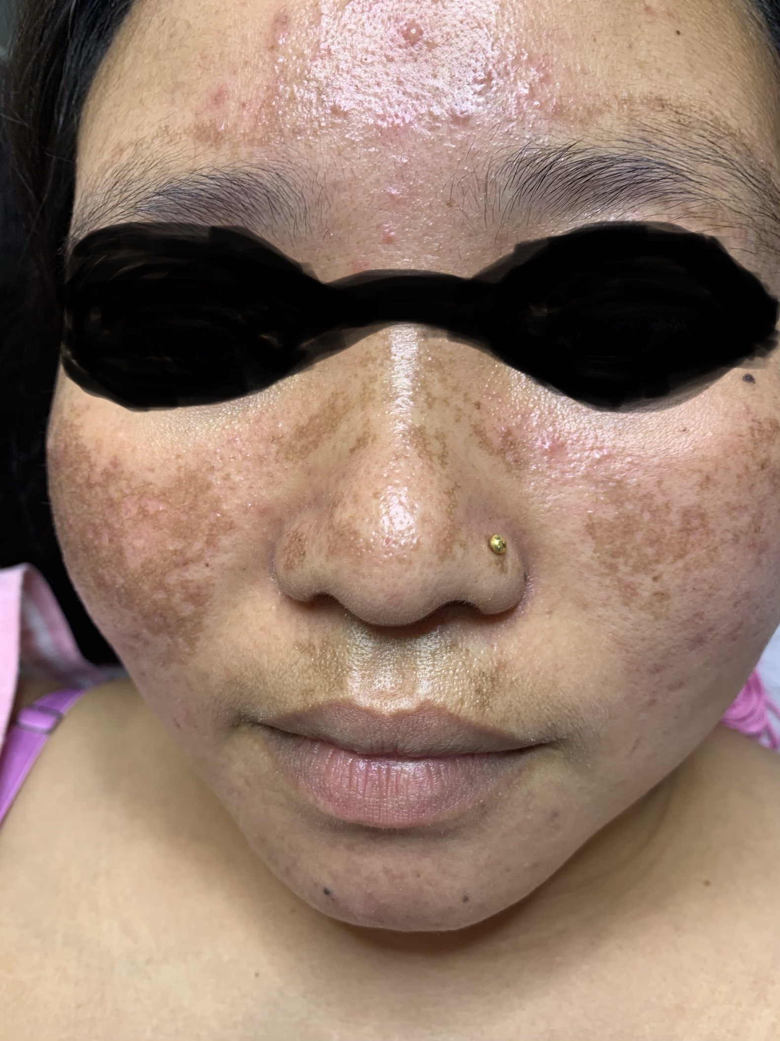 Fractional laser acne and scars result 7