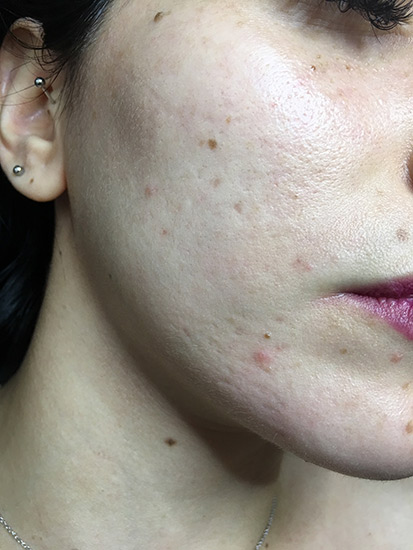 Fractional laser face result 1