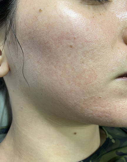 Fractional laser face result 2