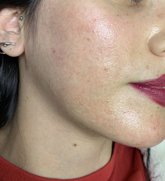 Fractional laser face result 3