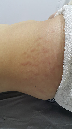 Fractional laser stretch marks result 1