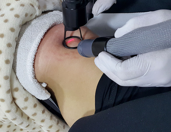 Fractional laser stretch marks result 2