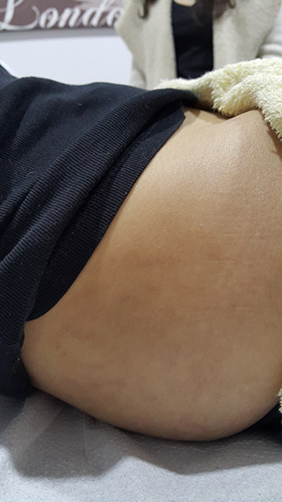 Fractional laser stretch marks result 3