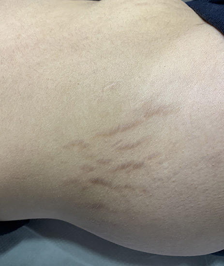 Fractional laser stretch marks result 4