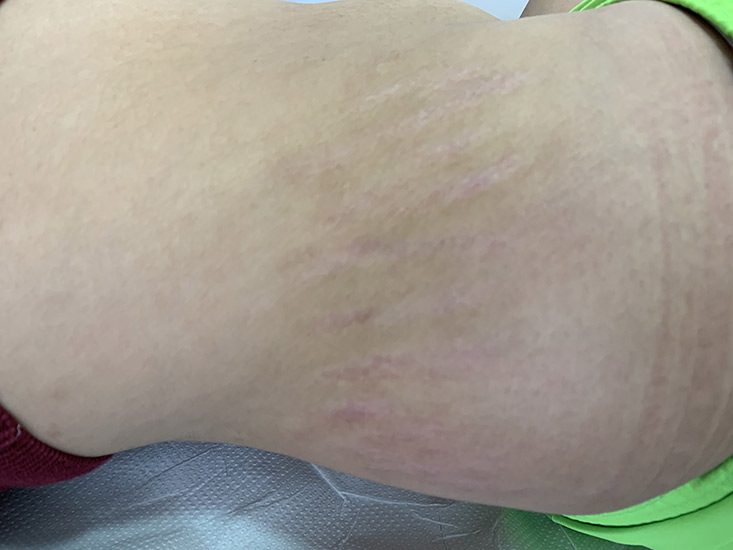 Fractional laser stretch marks result 5