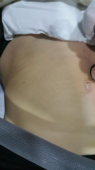 Fractional laser advanced stretch marks result 1