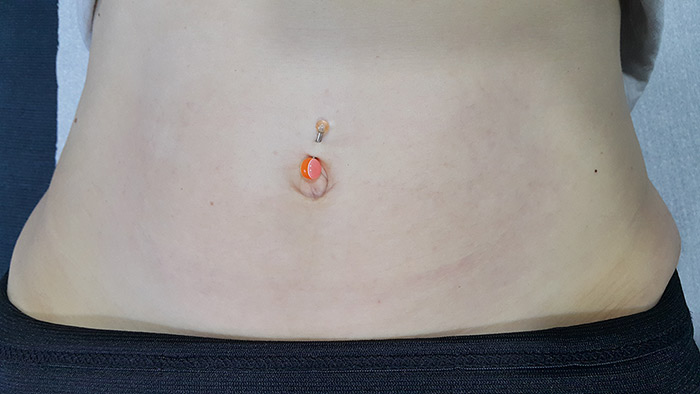 Fractional laser advanced stretch marks result 5