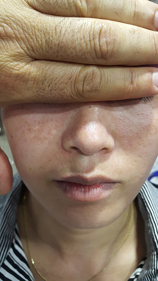 Fractional laser advanced stretch marks result 8