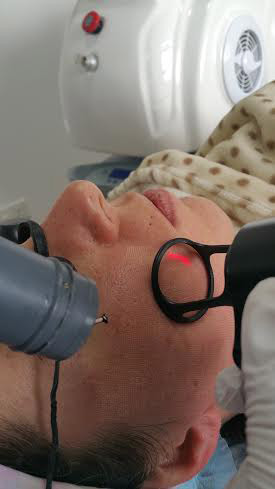 Fractional laser additional treatment result 1