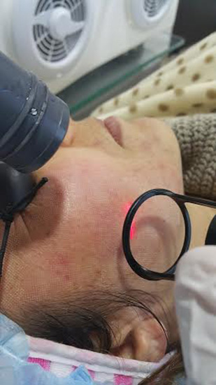 Fractional laser additional treatment result 3