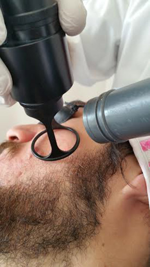 Fractional laser additional treatment result 4