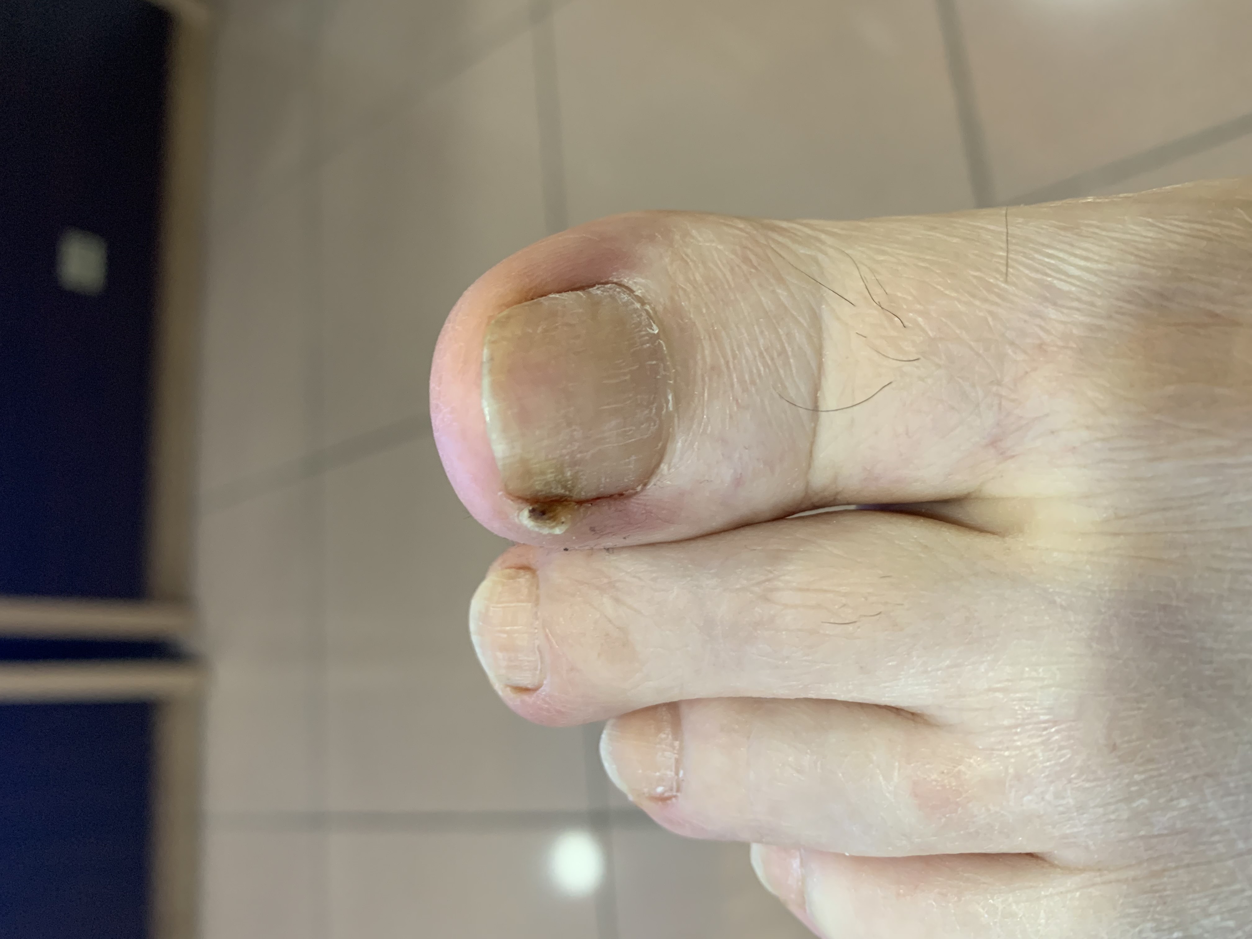 Laser nails fungus result 1