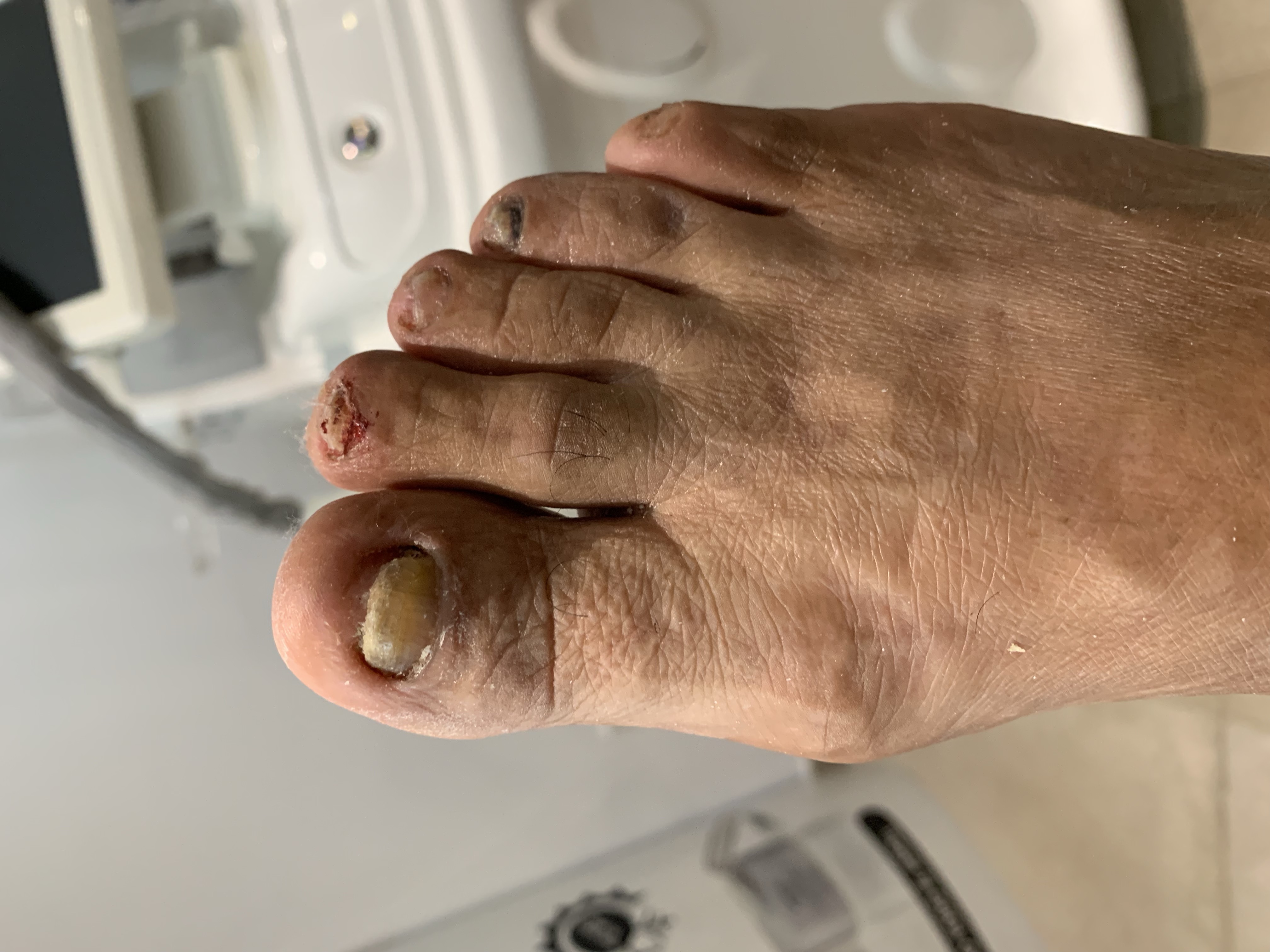 Laser nails fungus result 4