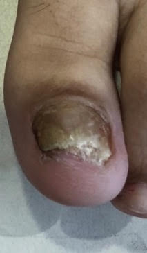 Laser nails fungus result 10