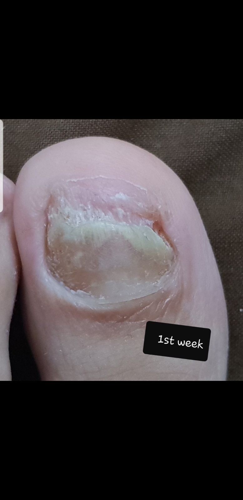 Laser nails fungus result 12