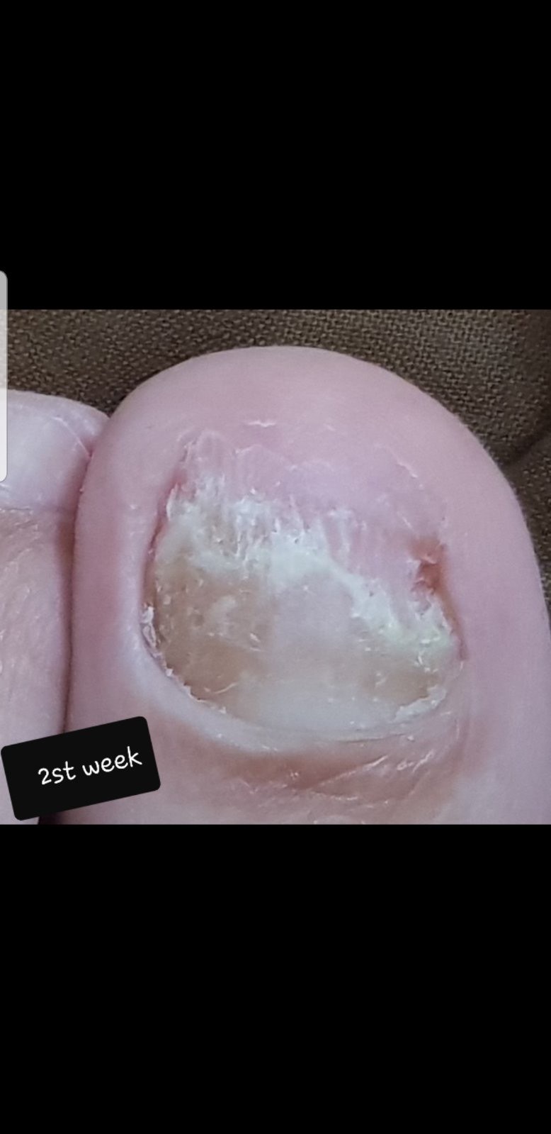 Laser nails fungus result 13