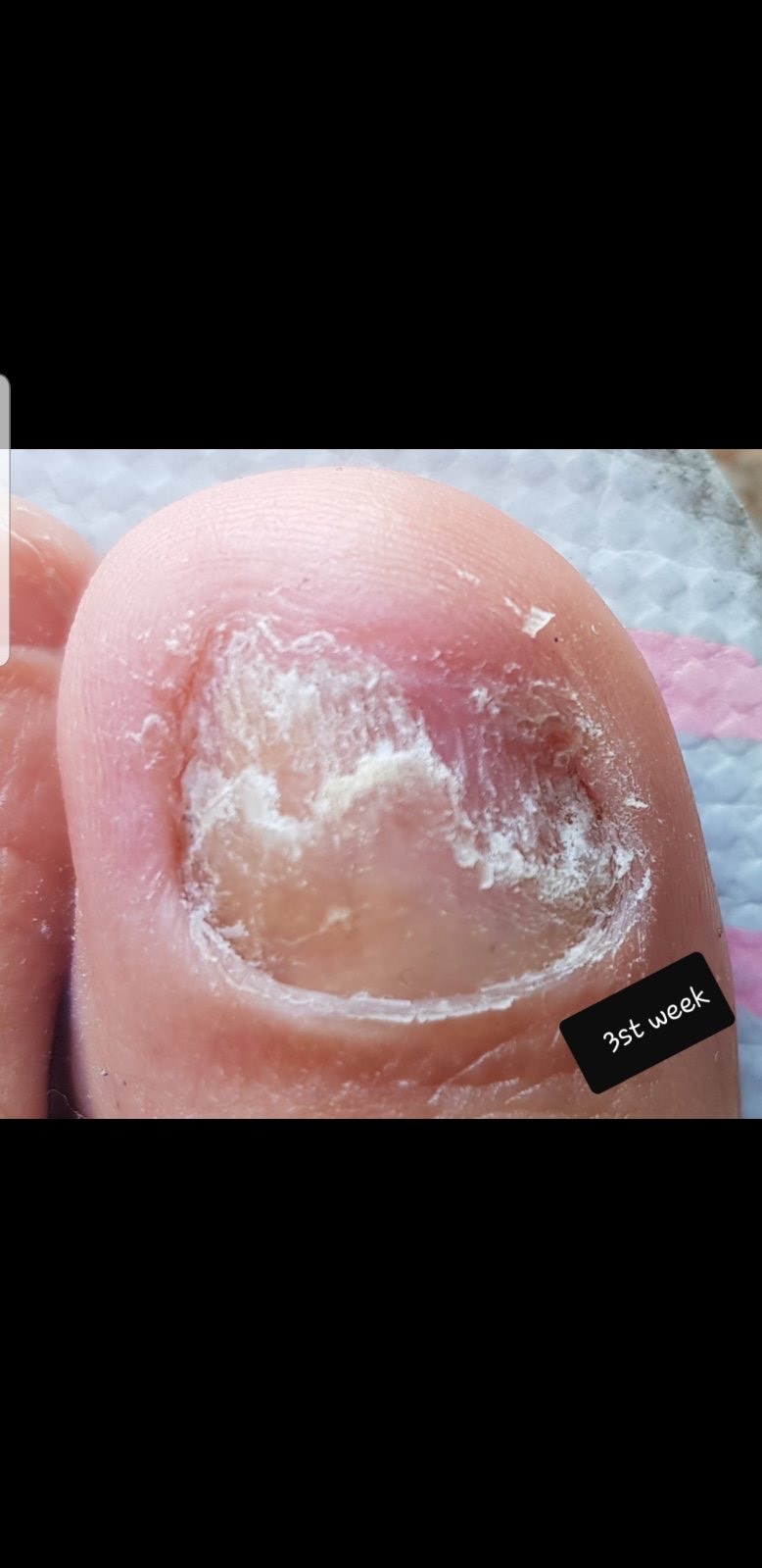 Laser nails fungus result 14