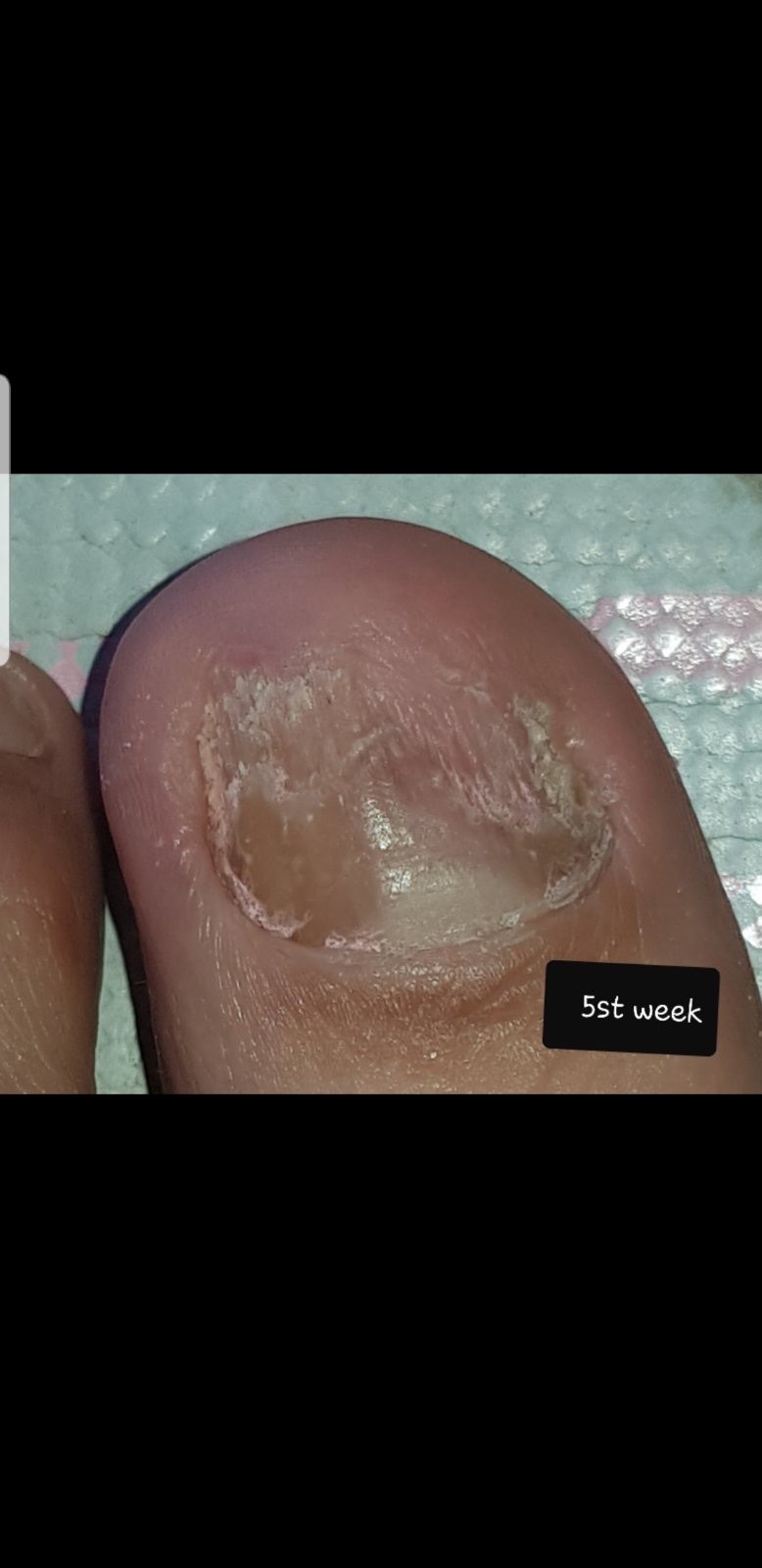 Laser nails fungus result 16