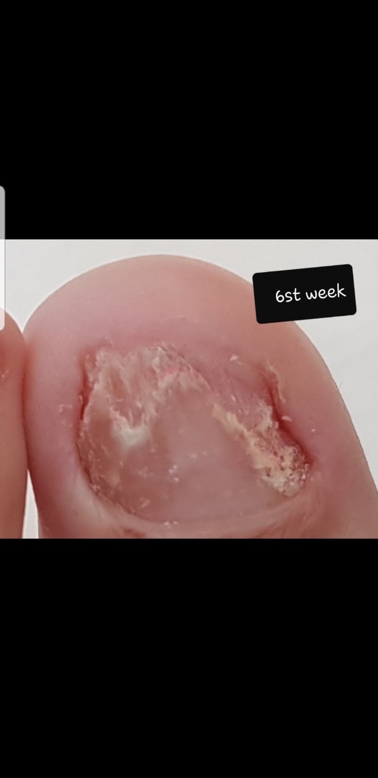 Laser nails fungus result 17