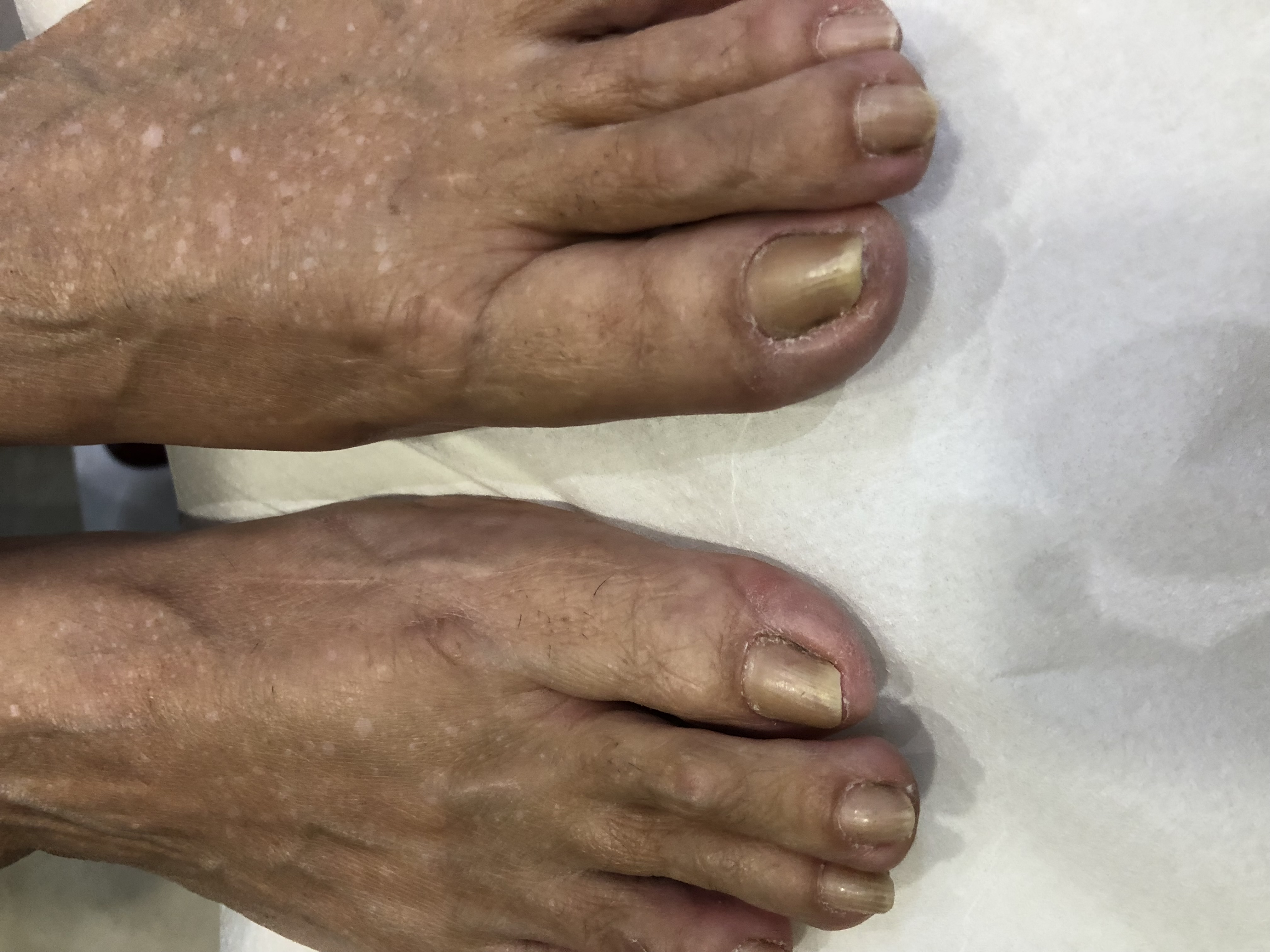 Laser nails fungus result 18