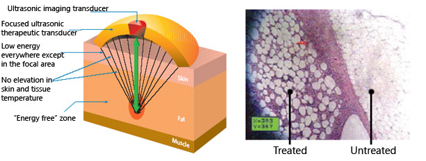 Liposonix gallery image 2