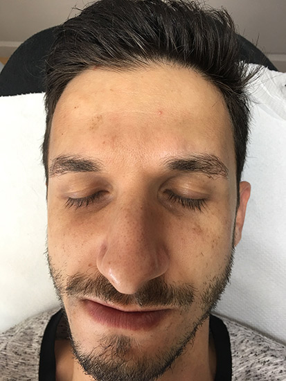 Carbon laser whitening result 1