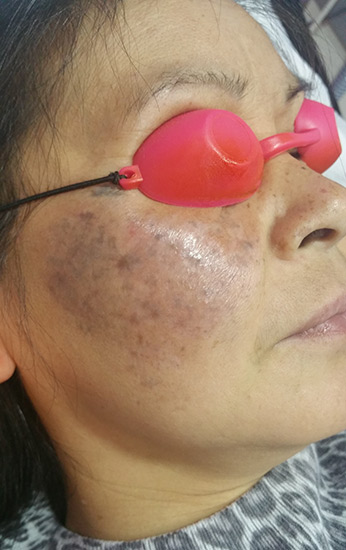 Carbon laser whitening result 5