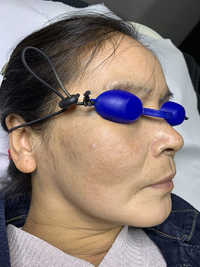 Carbon laser whitening result 6