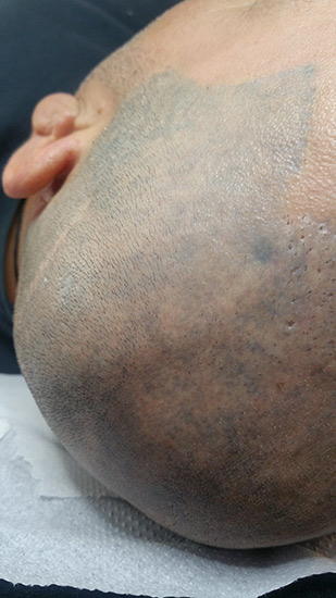 Laser tattoo removal before and after result 4