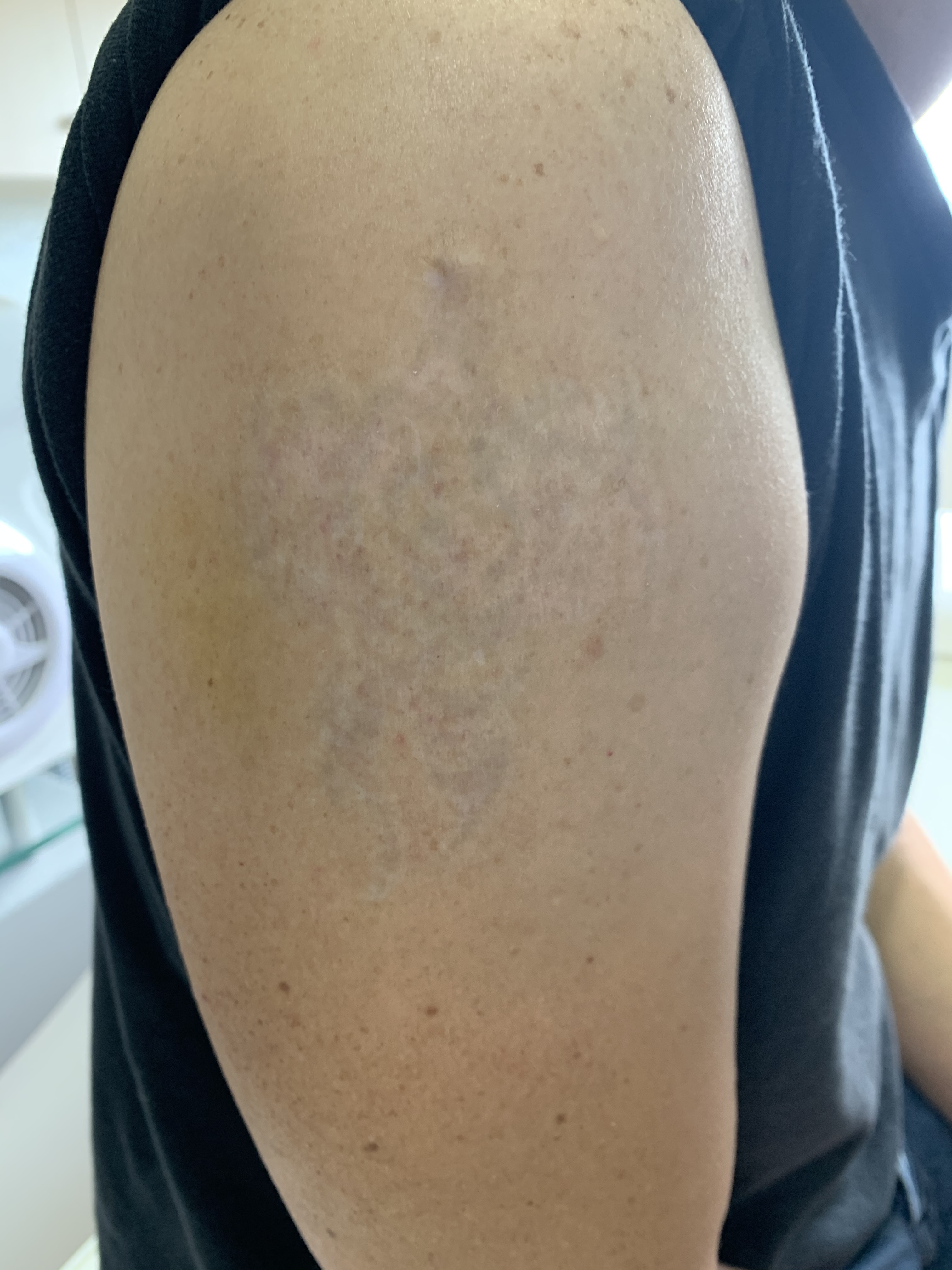 Laser tattoo removal before and after result 10