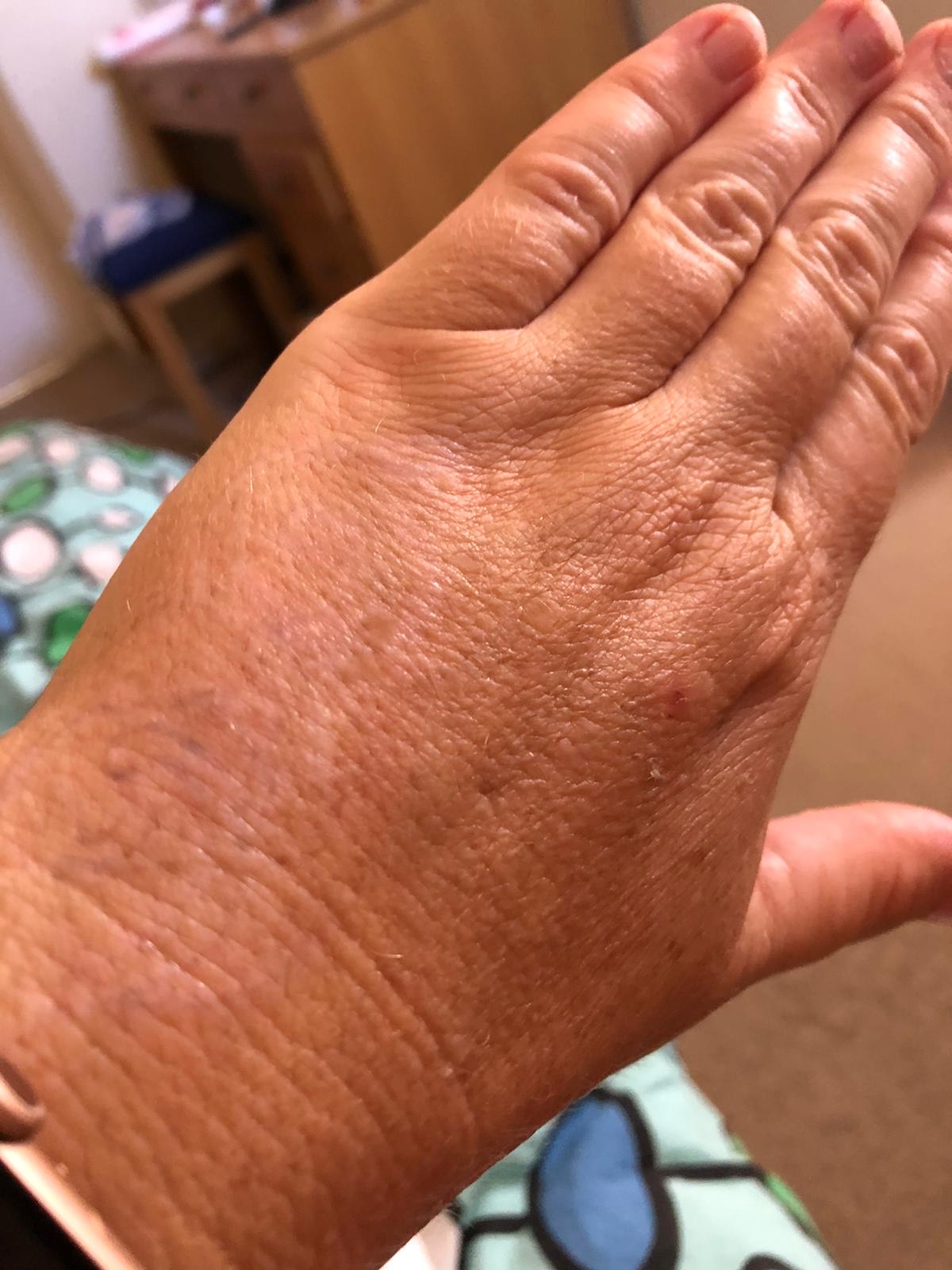 Laser tattoo removal before and after result 12